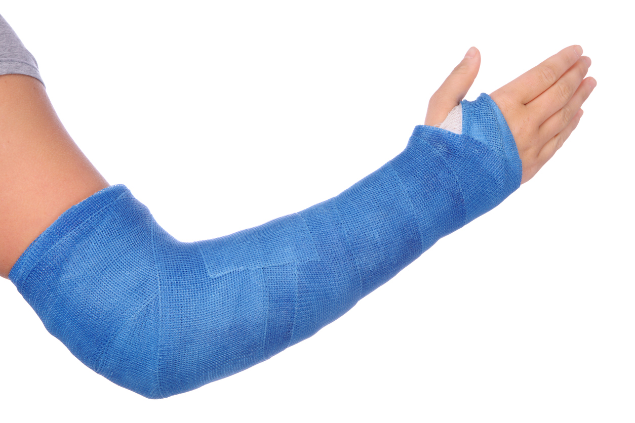 elbow cast