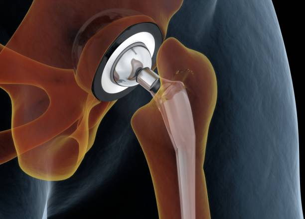 Reducing Post-Operative Pain from Hip Replacement